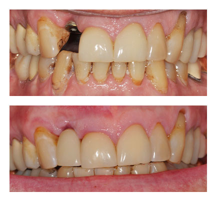Before and after picture of Dental Crown
