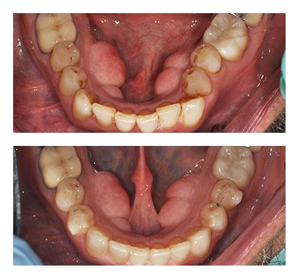 Before and after picture of a patient that had Invisalign