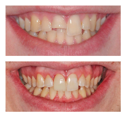 Before and after picture of Dental Crown