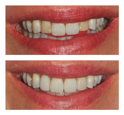Before and after picture of a dental veneers patient at Natick Dental Health