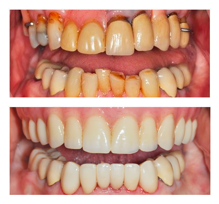 Cosmetic dentistry before and after picture of a Natick Dental Health patient
