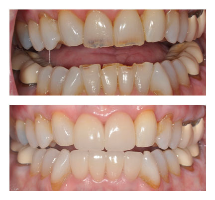 Before and after picture of Dental Crowns