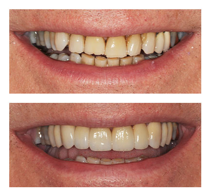 Before and after picture of Dental Crowns