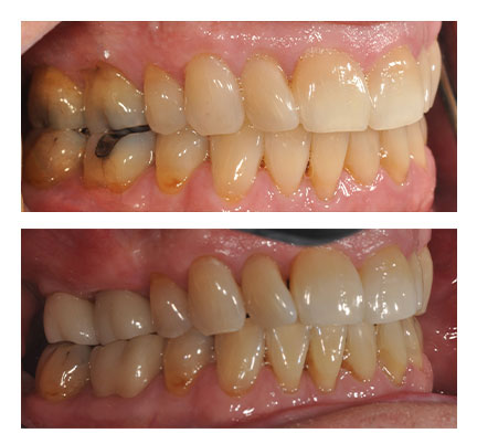 Before and after picture of Dental Crowns and Grafts