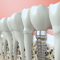 3D rendering of a dental implant and dental crown replacing a tooth