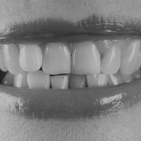 Black and white picture of exposed teeth