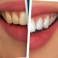 Side by side comparison of yellow and white teeth