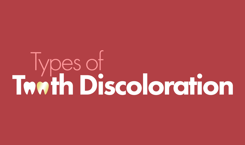 Graphic depicting tooth discoloration